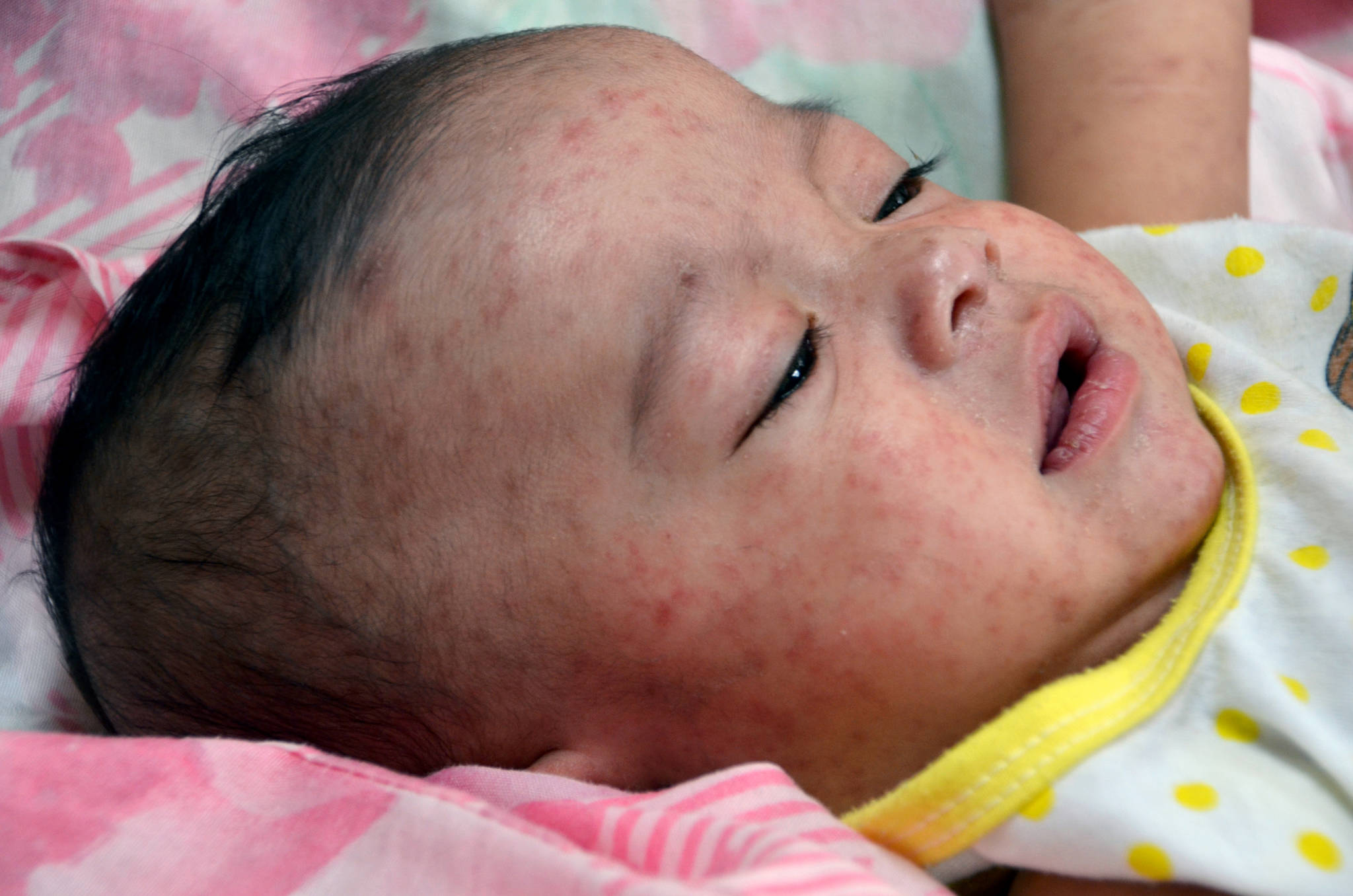 Measles outbreak spreads across Washington